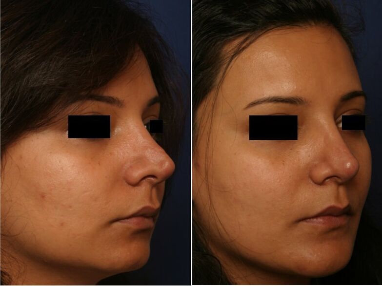 αποτέλεσμα πλαστικής χειρουργικής