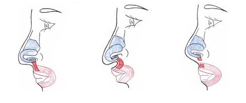 Αποκοπή τμήματος του ρινικού μυός