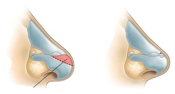 Διόρθωση σχήματος μύτης