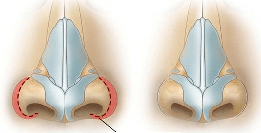 Μείωση ρουθούνιου