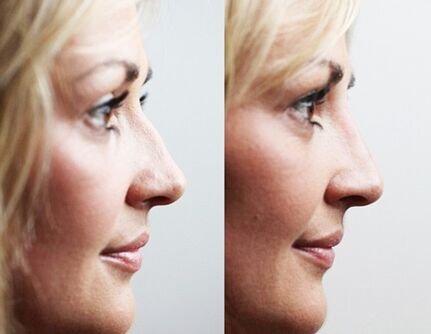 Πριν και μετά τη ρινοπλαστική με fillers