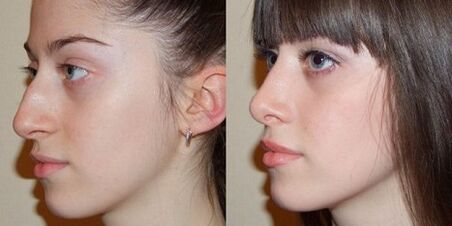 φωτογραφίες πριν και μετά τη ρινοπλαστική της μύτης